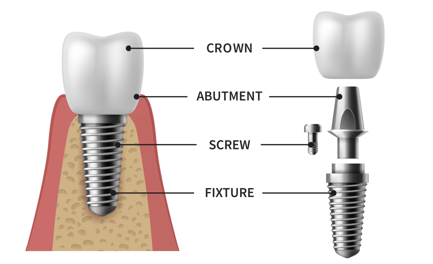 Dental Implants Naples, FL Periodontics & Implant Center of Naples